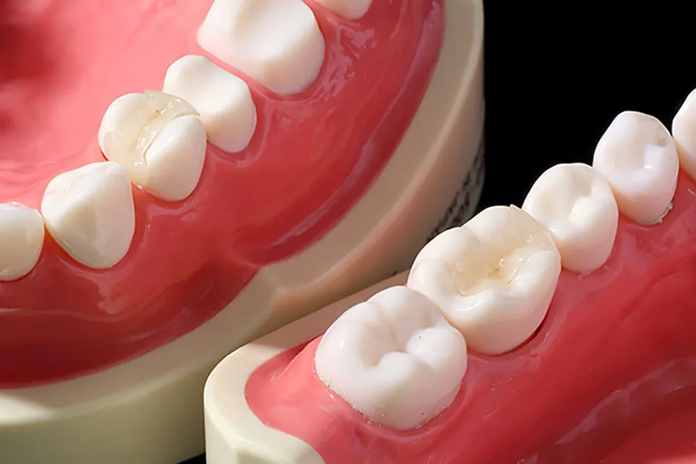 セラミックインレー